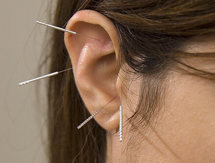 øre akupunktur